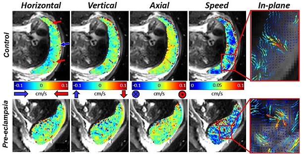 PLOSBiology's tweet photo. MRI sheds light on the function of the human #placenta, revealing a) slow net flow &amp; high, uniform oxygenation in healthy pregnancies b) changes in #preeclampsia, c) a new phenomenon, the ‘utero-placental pump’ @ppzpag &amp;co at @SPMIC_UoN in #PLOSBiology https://t.co/CPUCY5XaIu https://t.co/rVUhso59SY