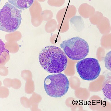 Immature cells with folded monocytoid nuclei mixed with abnormal eosinophils (arrow), containing large basophilic granules and more normal eosinophilic granules #harlequincell #AMML #M4EoS #Inv16 #CBFBMYH11fusion #hhpath #hemepath
