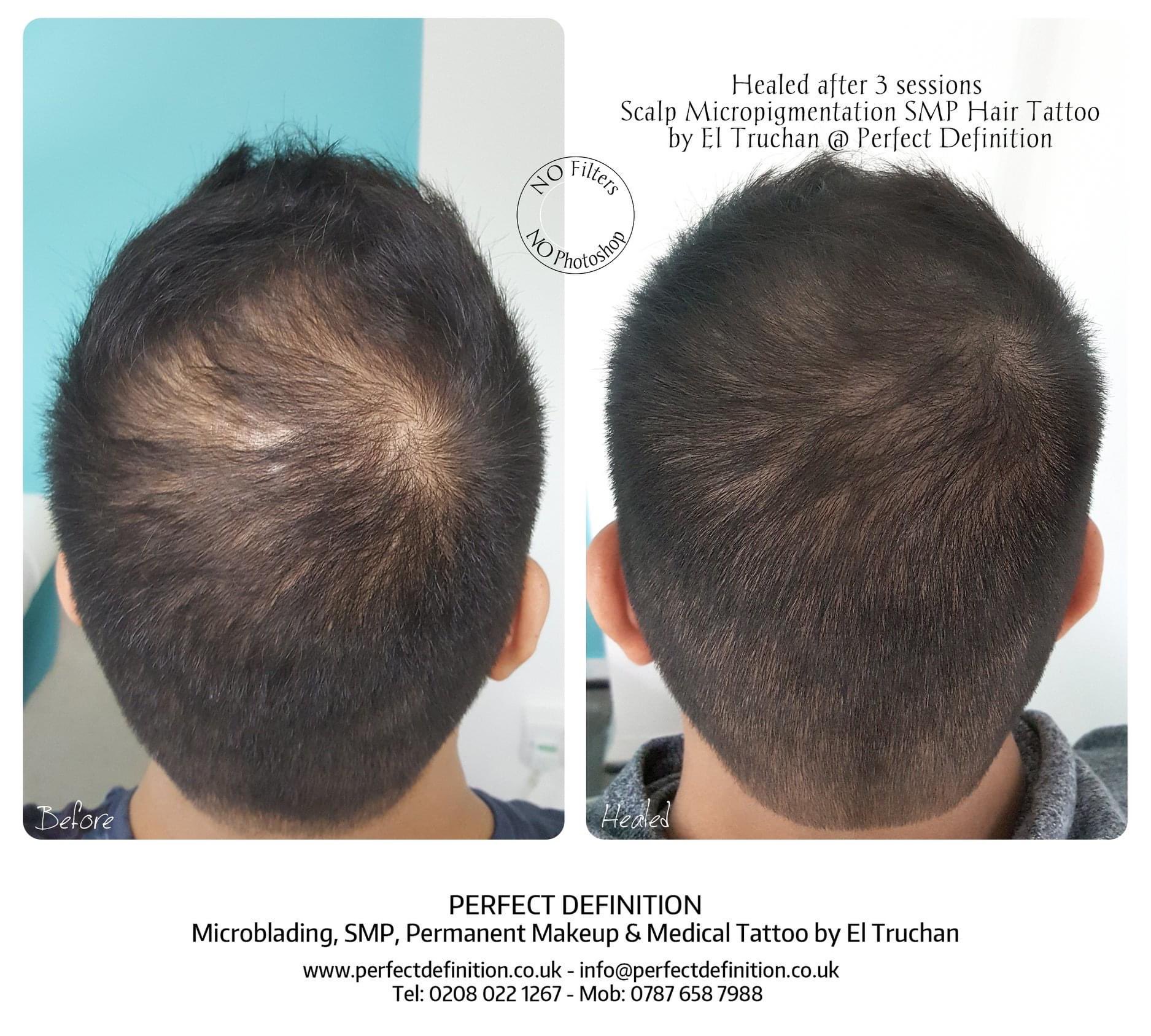 Our Clients  it  Before  After Scalp Micropigmentation for Men