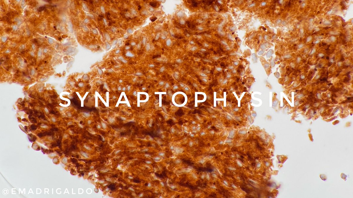 Thyroid nodule FNA
🔴 Malignant (Bethesda 6)
🔴 MEDULLARY thyroid carcinoma
⚫️ ➕calcitonin, synaptophysin, chromogranin
⚫️ ➖ thyroglobulin
⚫️ PAX8 (variable and weak)
⚫️ Cyto: round, plasmacytoid, polygonal or SPINDLE cells in nests, cords, or follicles

#cytoPath #FNAFriday