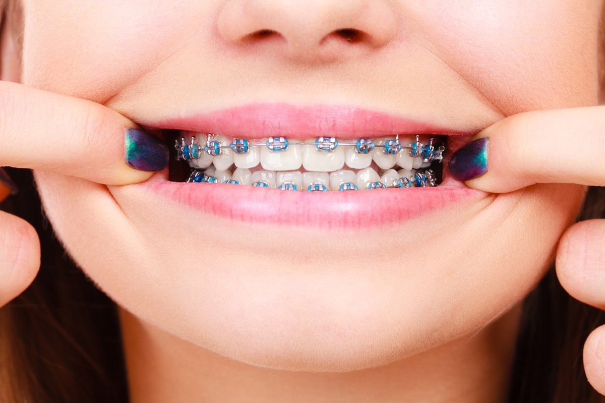 UnionFound's tweet image. Full treatment for Braces! Just one of the awesome items available on the #2020USEFonlineauction BIDDING STARTS MONDAY! @UnionSchools 
one.bidpal.net/2020usefauctio…