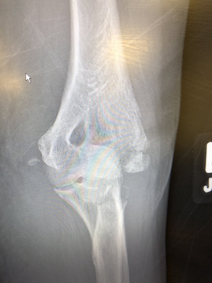  #fracturefriday  #OrthoTwitter  #handtwitter  @DrMoghtaderi  @AmyMMooreMD  @sanjkakar  @mike_hayton  @JuncturaTheorum  @hunter_alistair  @NuelleHandMD 55yo woman. FOOSH. Ouch. Go.