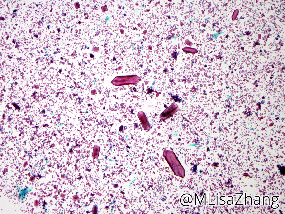 Parotid FNA with "plate-like" amylase crystals 💎 , associated with sialadenitis.
VS "floret-like" tyrosine crystals, which can be seen in pleomorphic adenomas and other neoplasms.

Feels like trivia fodder for <a href="/Sara_Jiang/">Xiaoyin "Sara" Jiang, MD (She/Her)</a>! 🤫

#FNAFriday #CytoPath #ENTPath #Pathology #pathboards