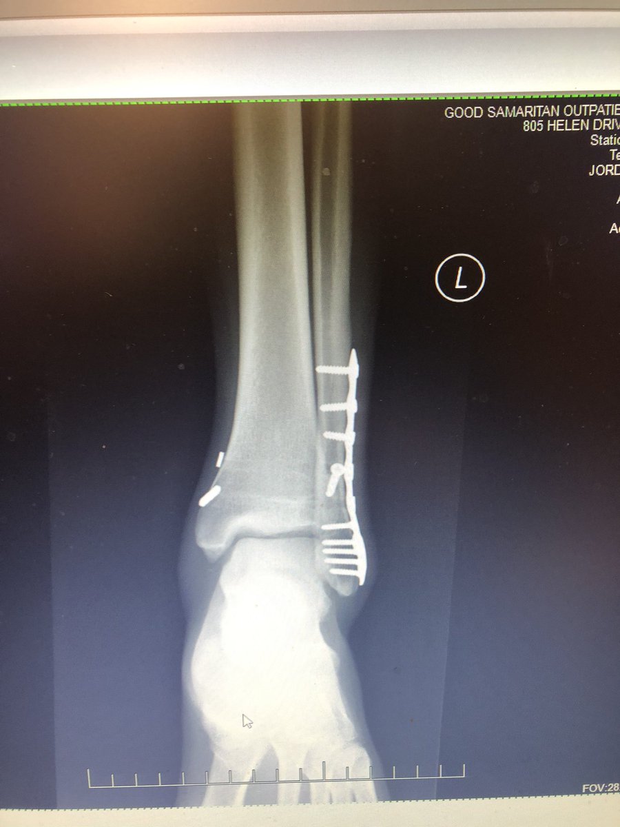 Big day today. In December my passion was on hold for some time. Don’t take a day for granted, enjoy every moment, and treasure the ones along the way who help you get there. Today I’m cleared to lace up the wheels again #blessed 🤫