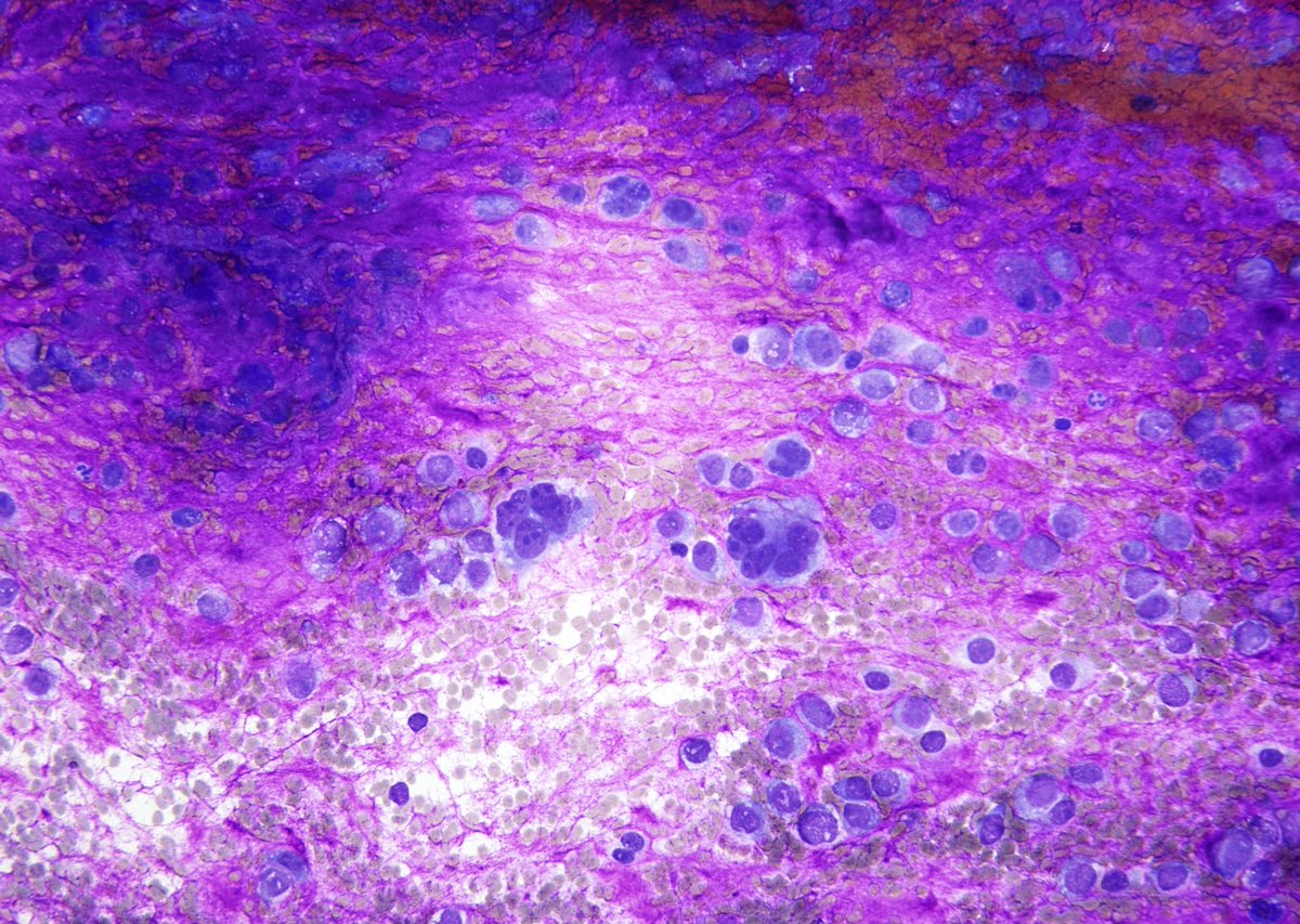 On low power, majority of you would think "PA from the Parotid". However, most would change the opinion on high power and once I disclose that the FNA came from a femoral lesion in a young male. Immature osteoid from "Osteosarcoma" appears extremely "myxoid".