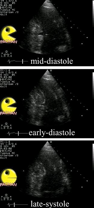 Nunzia Borrelli (@nunziaborrell12) on Twitter photo In the Pacman heart the VSD opens like a mouth in diastole #echofirst #cardiotwitter #cardiosmart #CHD <a href="/ESCardioNews/">European Society of Cardiology News</a> <a href="/ESC_Journals/">European Society of Cardiology Journals</a> academic.oup.com/ehjcimaging/ar… In the Pacman heart the VSD opens like a mouth in diastole #echofirst #cardiotwitter #cardiosmart #CHD <a href="/ESCardioNews/">European Society of Cardiology News</a> <a href="/ESC_Journals/">European Society of Cardiology Journals</a> academic.oup.com/ehjcimaging/ar…