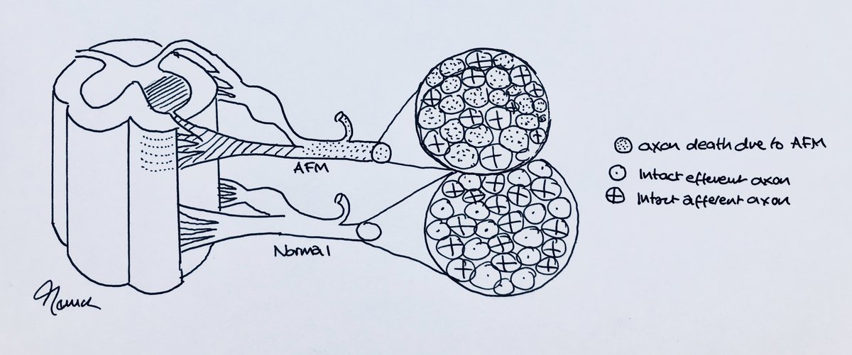 TJQPNI's tweet photo. And a #medicalillustration for education on  #Acuteflaccidmyelitis #AFM #AFP again free to use (credit @TJQPNI please). Showing loss of anterior horn cells and this de-efferentation of the nerve (the population of afferents remain functional). @GreatOrmondSt @RNOHnhs https://t.co/tS0CpCBRc4