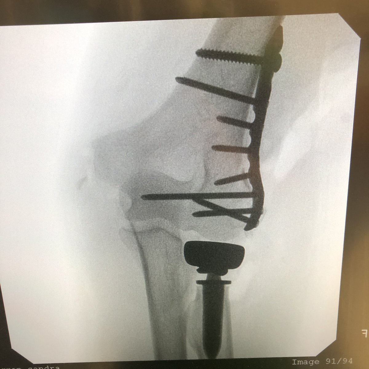 I threaded the plate over the guide wire for the IJS to make sure that it wouldn’t interfere with the axis pin if I needed to place it. I then reduced the fragments underneath the plate and got control of them with screws through the plate