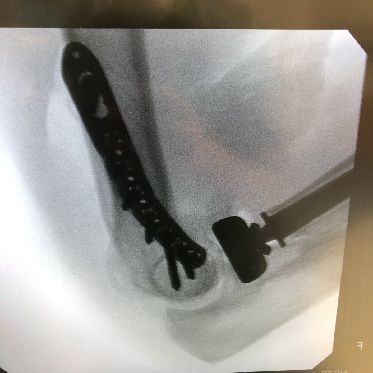 Stable in full ROM irrespective of supination or pronation  #fracturefriday  #Orthopedics  @AAOS1  @HandSurgeryAssn  @HandSociety