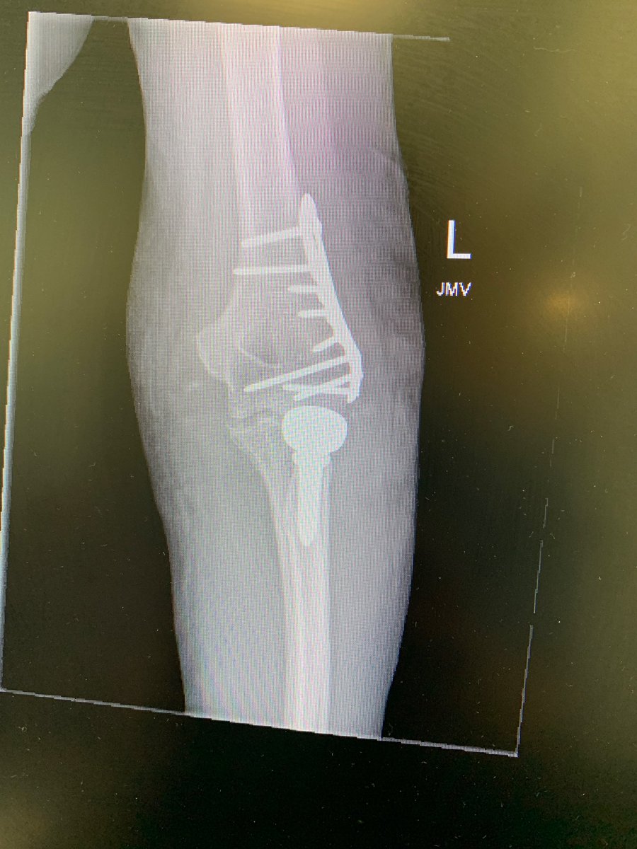 Not dislocated yet! Post mold splint. Out 5-8x daily for rom 90- full flexion. Increase extension 10 degrees each week. D/c splint at 4 weeks.  #handtherapy  #OT  @HandPodcast  @ChrisDyMD  @DKennedyHands