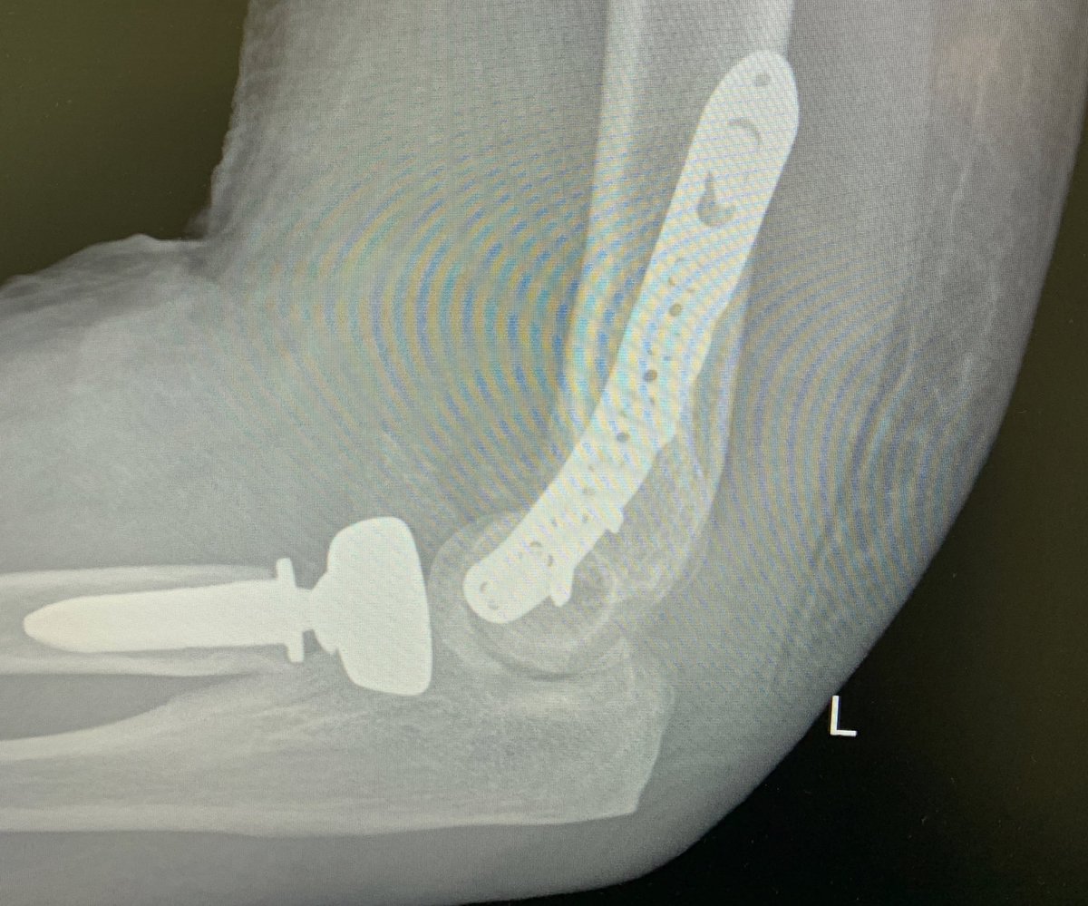 Not dislocated yet! Post mold splint. Out 5-8x daily for rom 90- full flexion. Increase extension 10 degrees each week. D/c splint at 4 weeks.  #handtherapy  #OT  @HandPodcast  @ChrisDyMD  @DKennedyHands