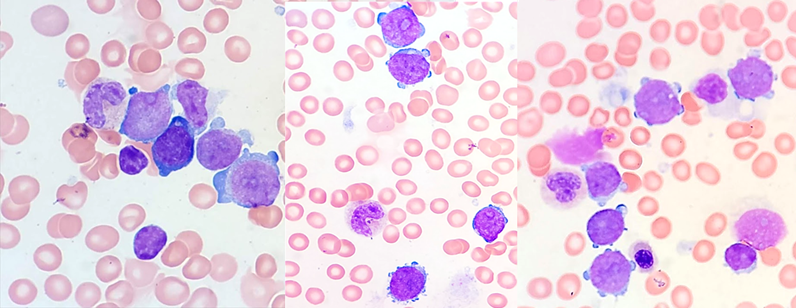 javidiparsijani's tweet photo. Myeloid leukemia associated with Down syndrome. The blasts have megakaryoblastic morphology and immunophenotype, including cytoplasmic buddings "blebs" and positivity for CD56, CD36, CD42b, CD11b, CD61(this one is dim), CD4(partial +) and CD34(-) https://t.co/ehLqfXBUr8