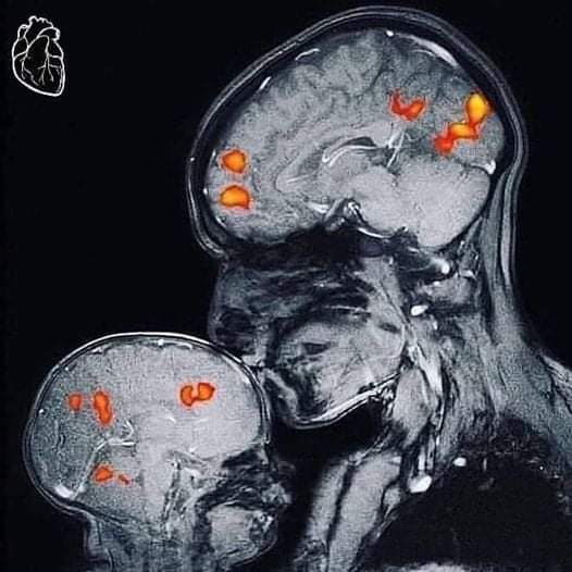 Yolotlzin_API's tweet photo. Resonancia magnética de la actividad cerebral de una madre besando a su hijo.
Su beso provoca una reacción química en el cerebro de su bebé que generó una explosión de oxitocina, una hormona que genera sentimientos de apego y afecto. Así se transfiere en amor.

#BuenosTratos https://t.co/yjg8IIF3bH