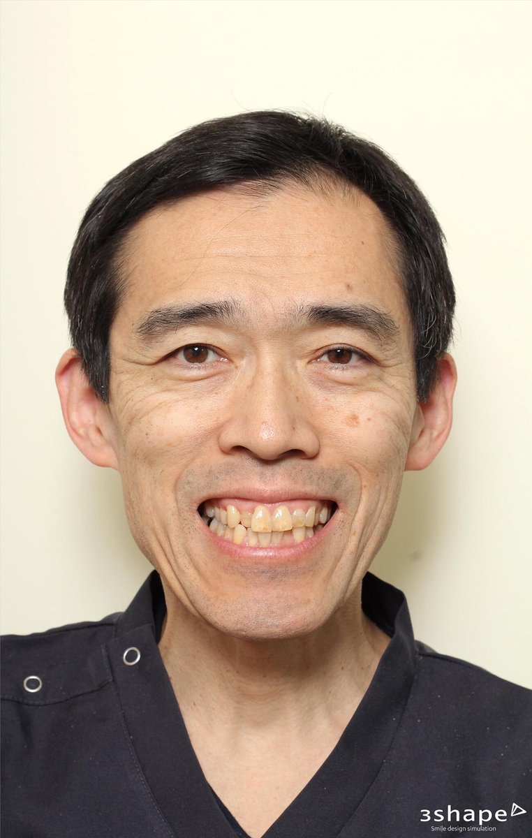 kamiura_dc's tweet photo. 3shape trios smile design
ビフォーアフター写真✨🦖
#3shape #trios3 #straumann #dental #iOS #scanner #3dprint #kamiuradentalclinic #上浦歯科クリニック #3dsmiledesign #口腔内スキャナー #札幌小樽 #インプラント #金属床義歯治療 #セラミック治療 https://t.co/hRya9lR9JI