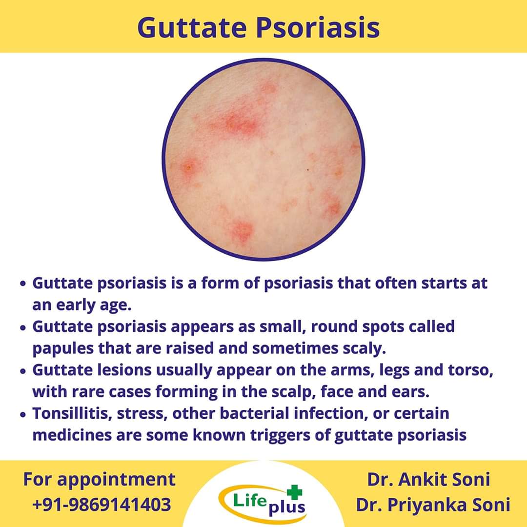 Guttate Psoriasis guttate-psoriasis
