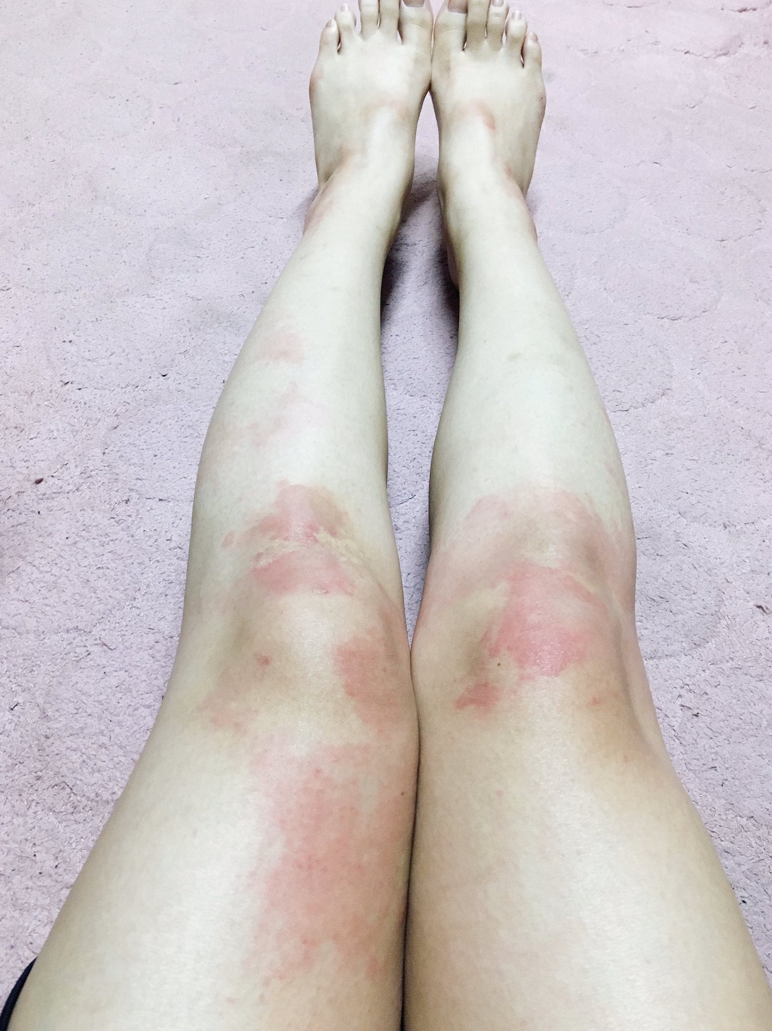 Kaori On Twitter: "水曜から蕁麻疹出始めて今日で4日目。 全身の痒みと寒気、吐き気、熱、手の震え、寒気、下痢、呼吸がひゅーひゅー言う症状で丸2日一睡もできず。  食べ物食べると吐く、水、薬飲むと吐く。おかげで3キロ痩せました。 Https://T.co/Cqmful7Rvu" / Twitter