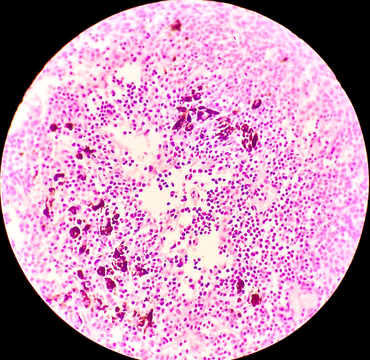 howaydadabbas's tweet photo. 19 ys female mesenteric lymph node in EGJ during prophylactic gastrectomy https://t.co/VzTgf9hQHG