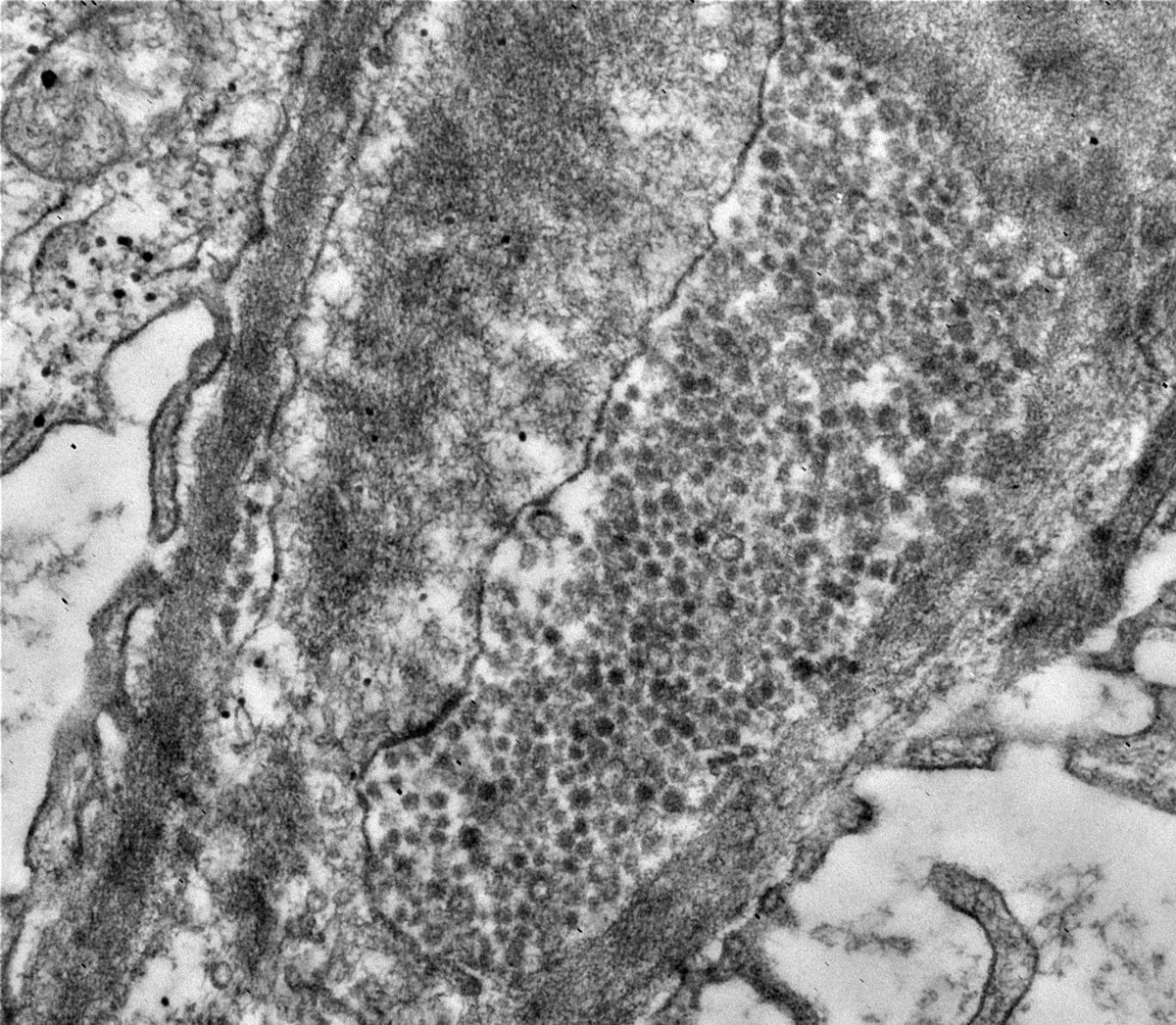 draalok's tweet image. #renalpath #askrenal #TwitterPath #electronmicroscopy #ultrastructure @askrenal Subepithelial spherules: enigmatic structures resembling viral particles.. possibly derived from visceral epithelial cell cytoplasm. Any thoughts on origin &amp;amp; significance?