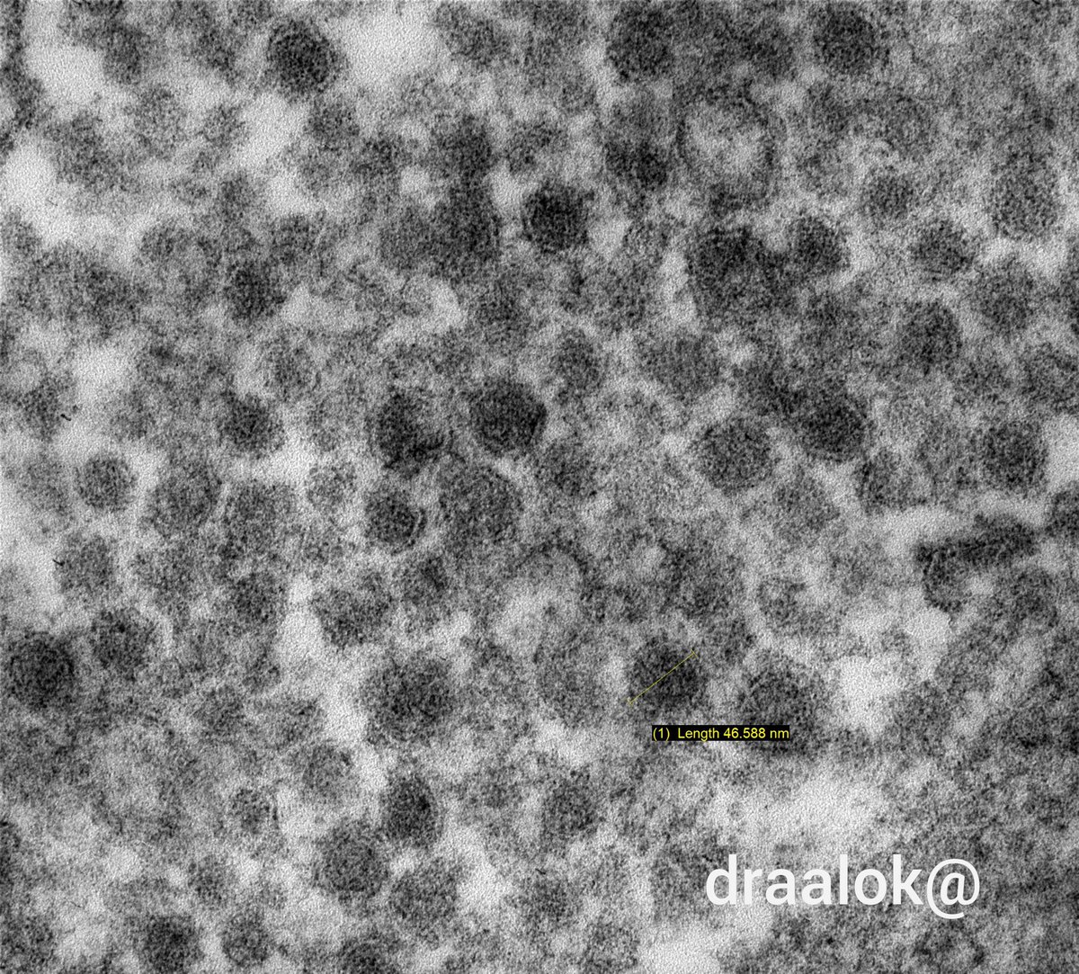 draalok's tweet image. #renalpath #askrenal #TwitterPath #electronmicroscopy #ultrastructure @askrenal Subepithelial spherules: enigmatic structures resembling viral particles.. possibly derived from visceral epithelial cell cytoplasm. Any thoughts on origin &amp;amp; significance?