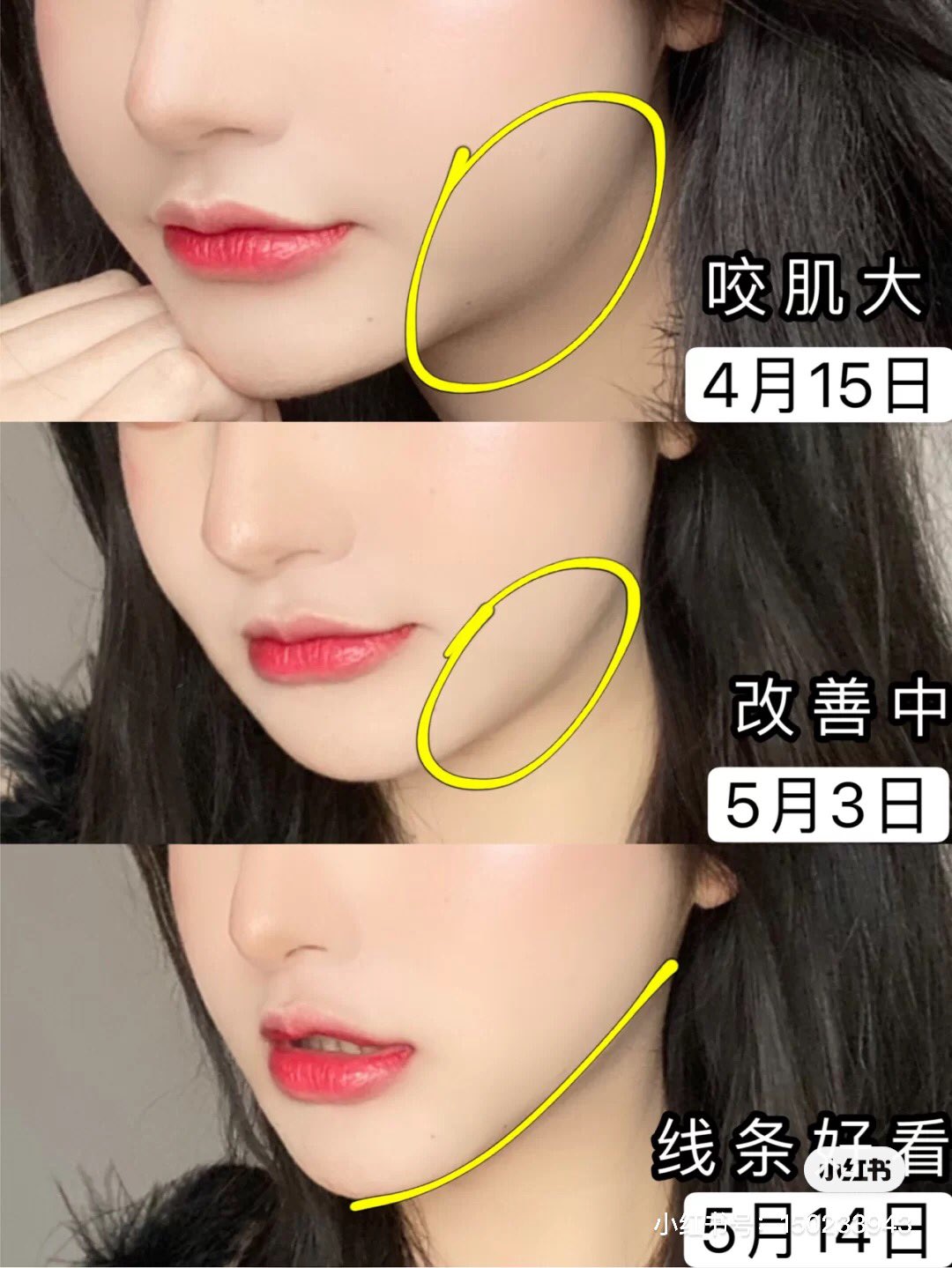 O Xrhsths 𓂃 室長さん Sto Twitter みんなエラのボリュームなくしたいと思うけどまったくなかったら立体感のない長細顔になるね 私も輪郭シャキーンとしたくて色々やったけど面長加速したもん 下顎の横幅はある程度ないと輪郭が間延びする 童顔目指してる人は横幅