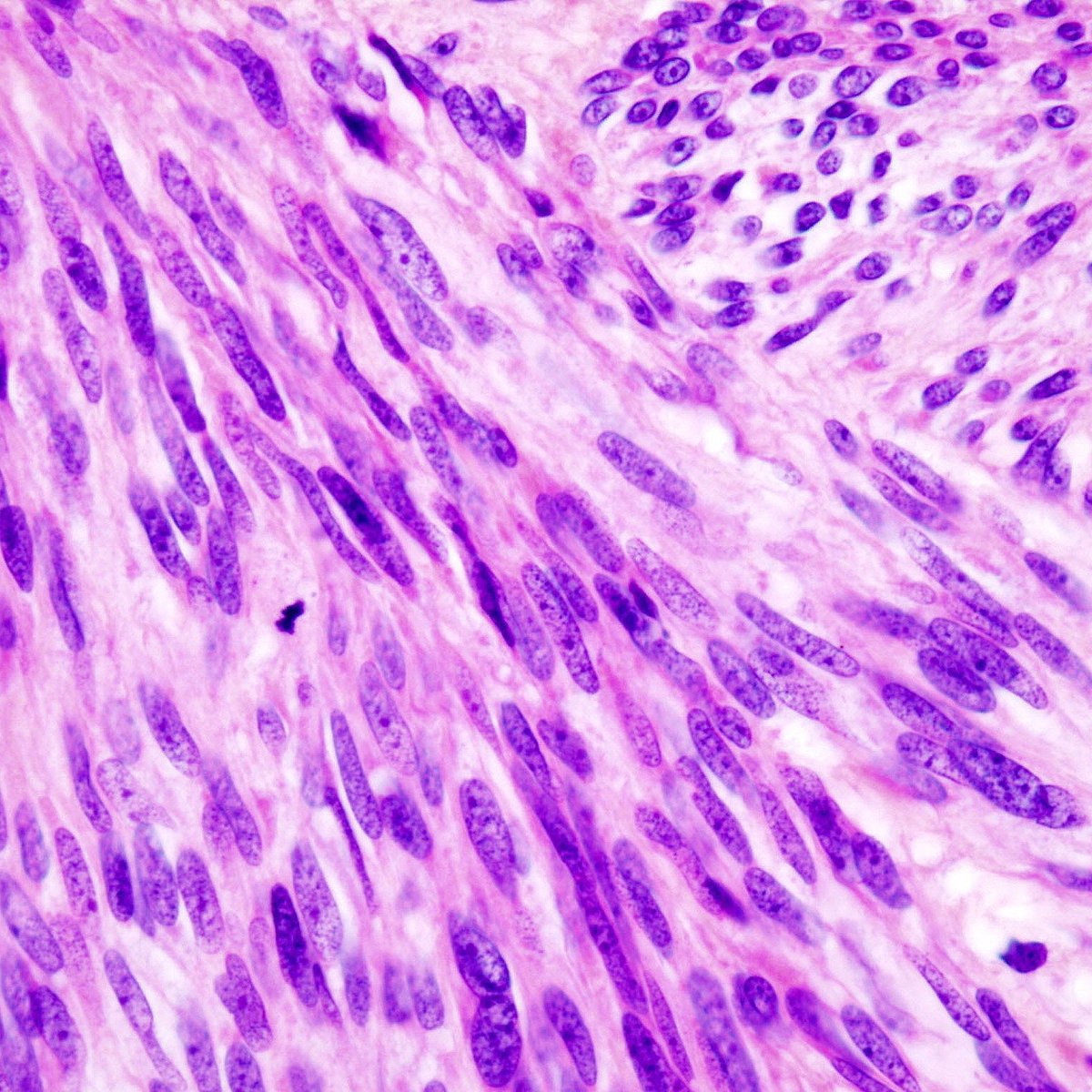 Medschool MCQ 15:
Most appropriate marker of GIST:
a) CD117
b) CD 34
c) CD 23
d) S-100
#Pathology #Pathologymcq #medschool