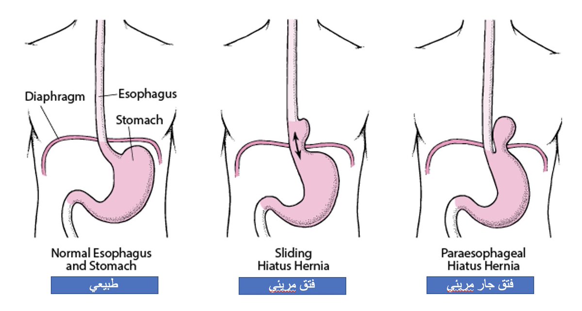 Диафрагмальный пищевода. ГЭРБ грыжа пищеводного отверстия диафрагмы. Скользящая грыжа в желудке операция. Грыжа пищеводного отверстия диафрагмы операция. Хиатальная грыжа желудка что это.
