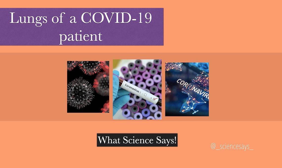 sciencesays3's tweet photo. What Chest X-Ray of a Covid-19 patient looks like. 
Original data obtained from Dr. Kartik Pande, JJ Mumbai. 
#Covid_19 #ARDS #xray #Quarantine #Science #MedTwitter #AcademicChatter #AcademicTwitter #pandemic2020 https://t.co/W46hFcYxjZ