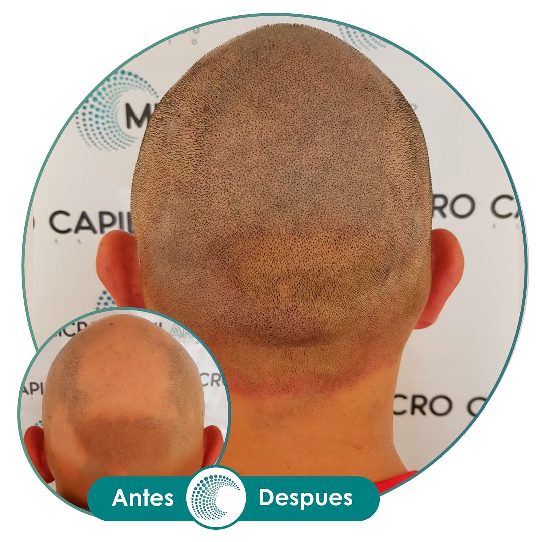 MicroCapilart's tweet photo. Alopecia Areata, un tipo de alopecia que inicia como un círculo que se va ampliando hasta eliminar el cabello en la zona y finalmente no quedan folículos.⁠
⁠
No solo afecta la cabeza, sino también las cejas, pestañas, barba y todos los folículos del cuerpo.⁠
⁠
#alopeciaareata https://t.co/JFSuAS0yW4