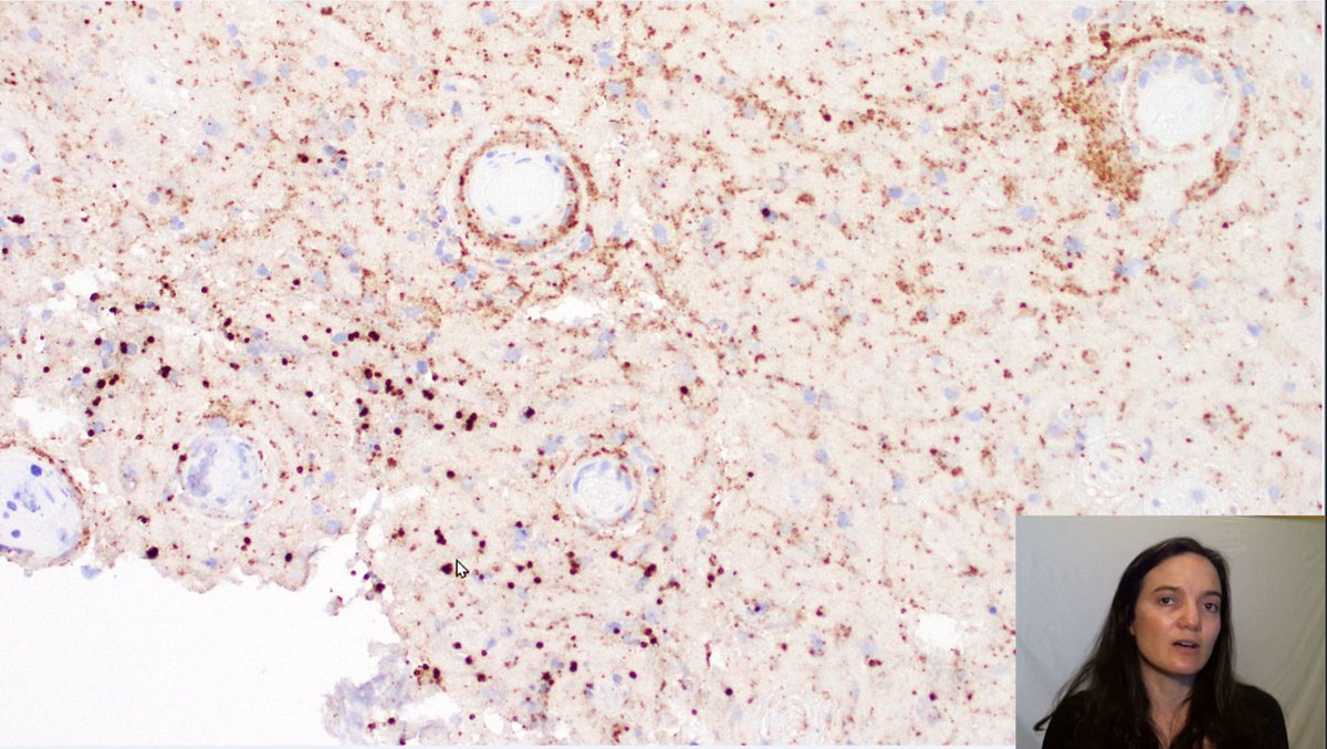 Adventures in Neuropathology tweet media