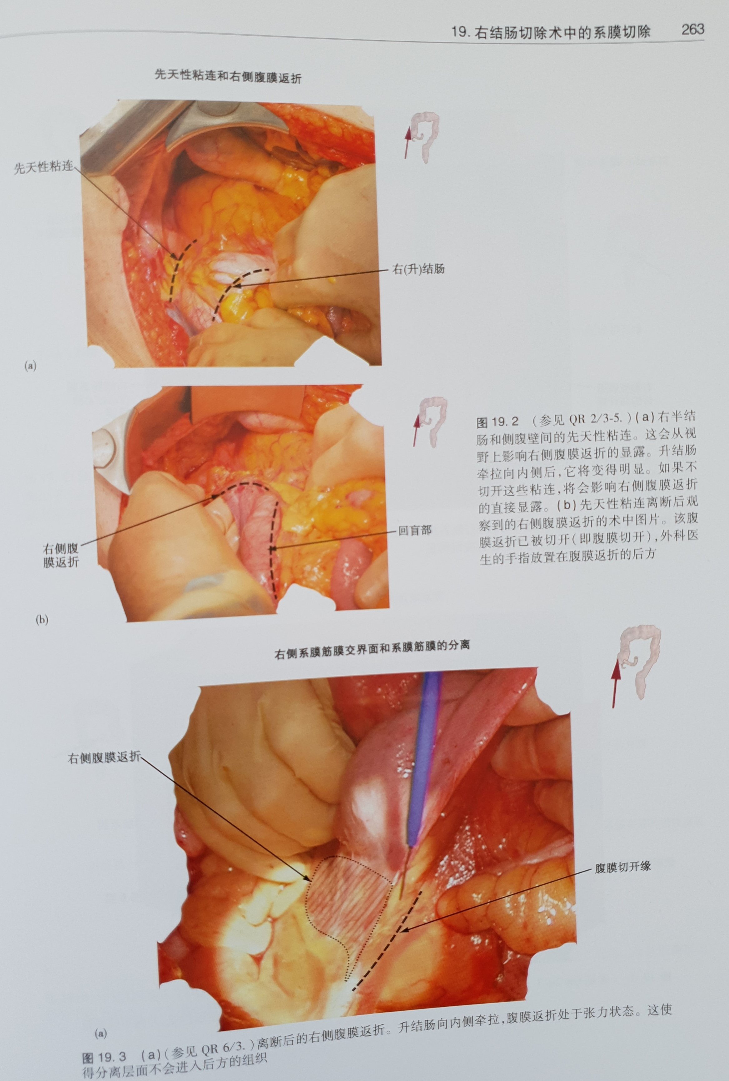 J Calvin Coffey na platformě X: „胃肠外科手术系膜解剖原理 J Calvin Coffey na platformě X: „胃肠外科手术系膜解剖原理