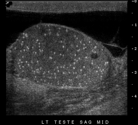 Scrotal ultrasound performed related to clinical concern for epididymo-orchitis. Incidental finding noted (see image). Diagnosis/follow up plan?  #POCUS  #FOAMed  #FOAMus  #IMPOCUS  #MedEd  #ultrasound  @medpedshosp  @ACEP_EUS  @HeyDrNik  @cianmcdermott  @PhilipsPOCUS  @thepocusatlas