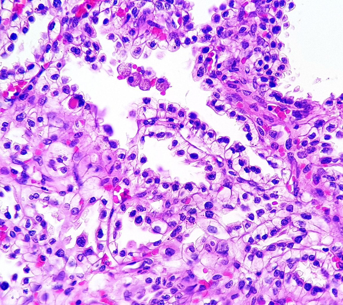 67 yo male patient with a 2.8 cm renal mass.

Beautiful Clear Cell Papillary RCC. #GUpath #grosspath #pathology #uropath