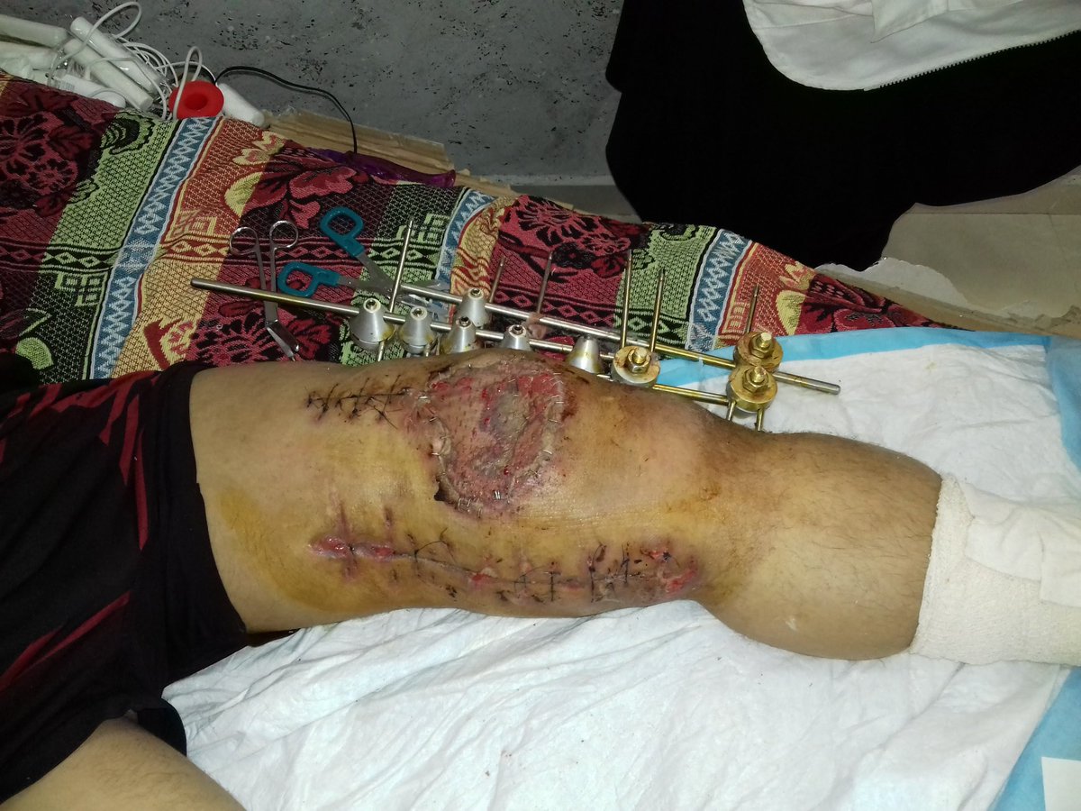 WorldMarketin15's tweet photo. A young man who was shot in the leg while doing humanitarian work,if he did not perform surgery, he will lose his leg. Donate for him to save his life. This Paypal account.
https://t.co/aOii525lSj
WhatsApp 00970595500848
#BLACK_LIVES_MATTER #PolisiminYanındayım #Somos70porcento https://t.co/pIPKLvCDrU