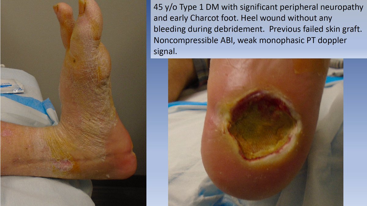 Watts_IR's tweet photo. Instructional recent case showing devastating effect of loss of neuroprotection and tibial artery disease in young diabetic. 20 minutes case will hopefully have a long lasting impact working hand in hand with my podiatry colleague. #CLIFighters #IRAD @SIRRFS @kmadass @LessneVIR https://t.co/ojQC03ph6q