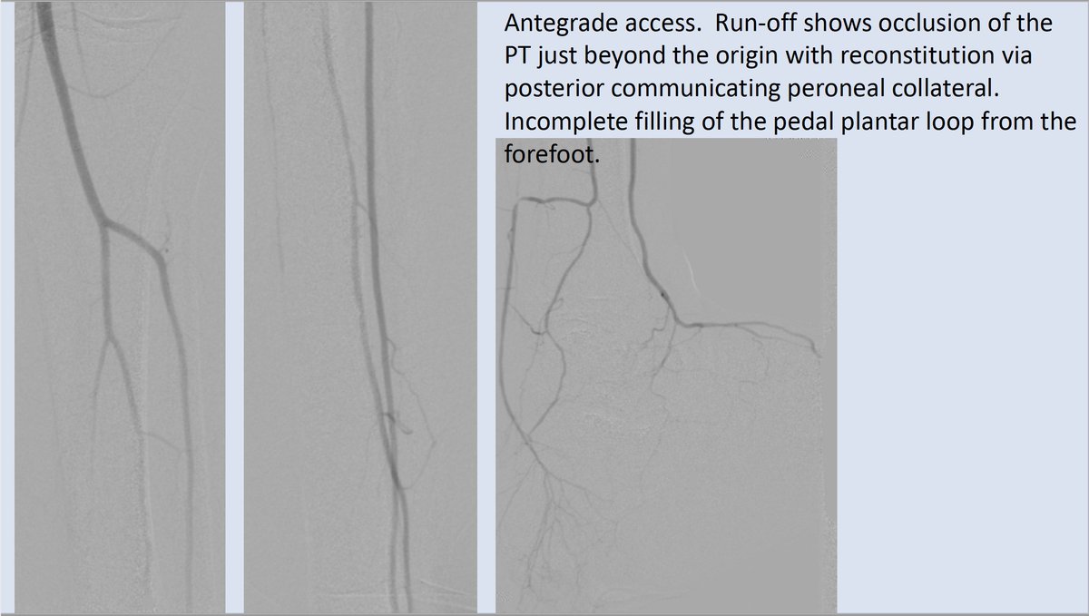 Watts_IR's tweet photo. Instructional recent case showing devastating effect of loss of neuroprotection and tibial artery disease in young diabetic. 20 minutes case will hopefully have a long lasting impact working hand in hand with my podiatry colleague. #CLIFighters #IRAD @SIRRFS @kmadass @LessneVIR https://t.co/ojQC03ph6q