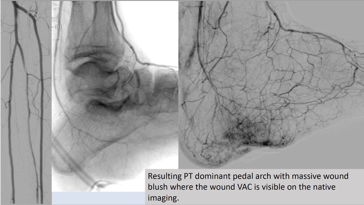 Instructional recent case showing devastating effect of loss of neuroprotection and tibial artery disease in young diabetic. 20 minutes case will hopefully have a long lasting impact working hand in hand with my podiatry colleague. #CLIFighters #IRAD <a href="/SIRRFS/">SIR RFS</a> <a href="/kmadass/">Kumar Madassery</a> <a href="/LessneVIR/">Mark Lessne, MD</a>