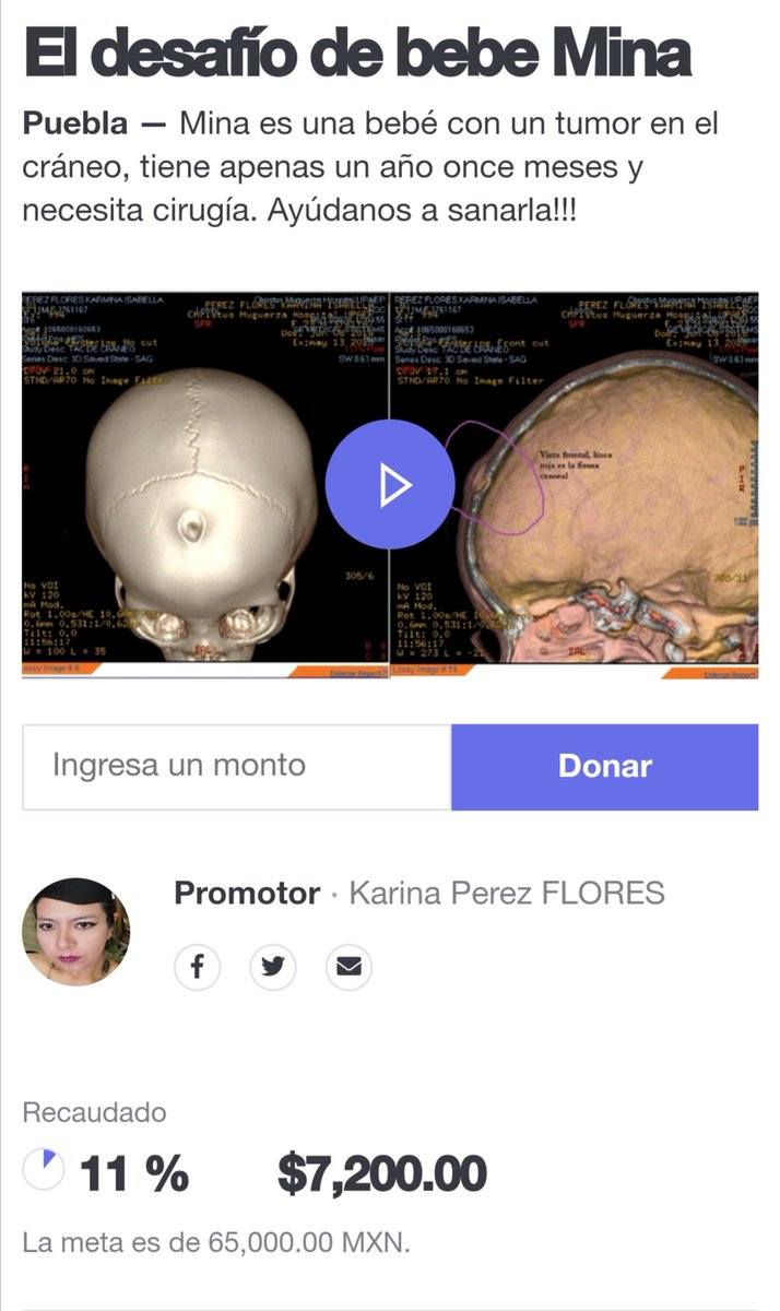 Apoyando a nuestra causa "El desafío de bebé Mina"

donadora.org/mina

Estaremos en entrevista mañana con PB Comunicaciones. 

Trasmisión por facebook live, domingo 31 de mayo, 7pm

facebook.com/pb.comunicacio…