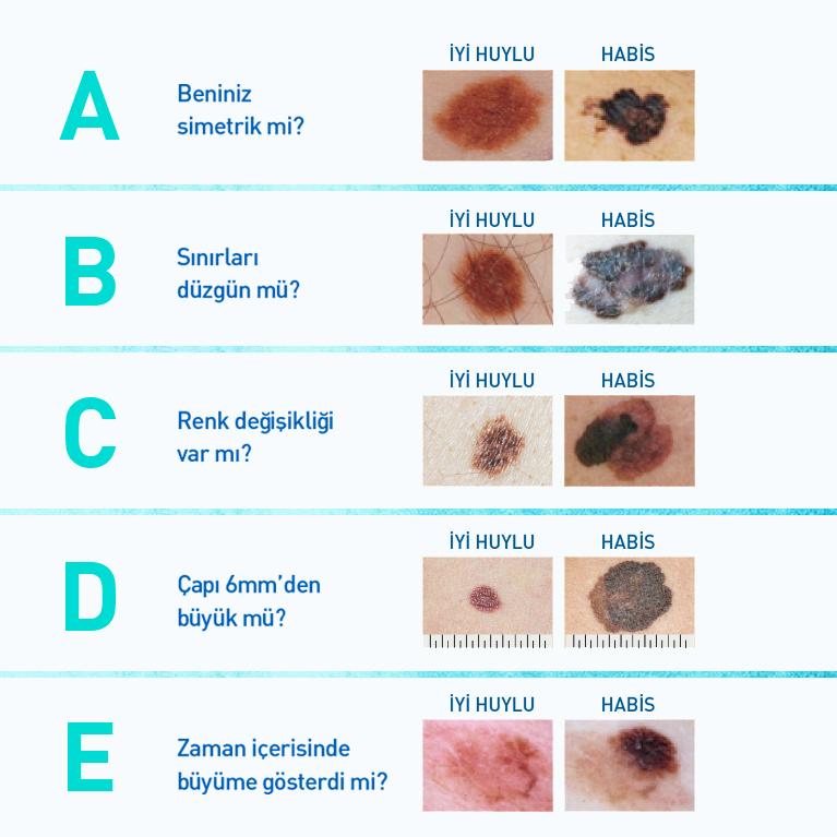 melanomtr's tweet photo. Melanoma bakarken, melanomun ABCDE'sini unutmayın.
#melanoma #melanomaawareness #melanom #makeskinchecksmonthly #worldmelanomamonth #wmm2020 #aylıkciltkontrolleriniziyapın #melanomfarkındalığı #melanomtr https://t.co/JHjAnHTdFY