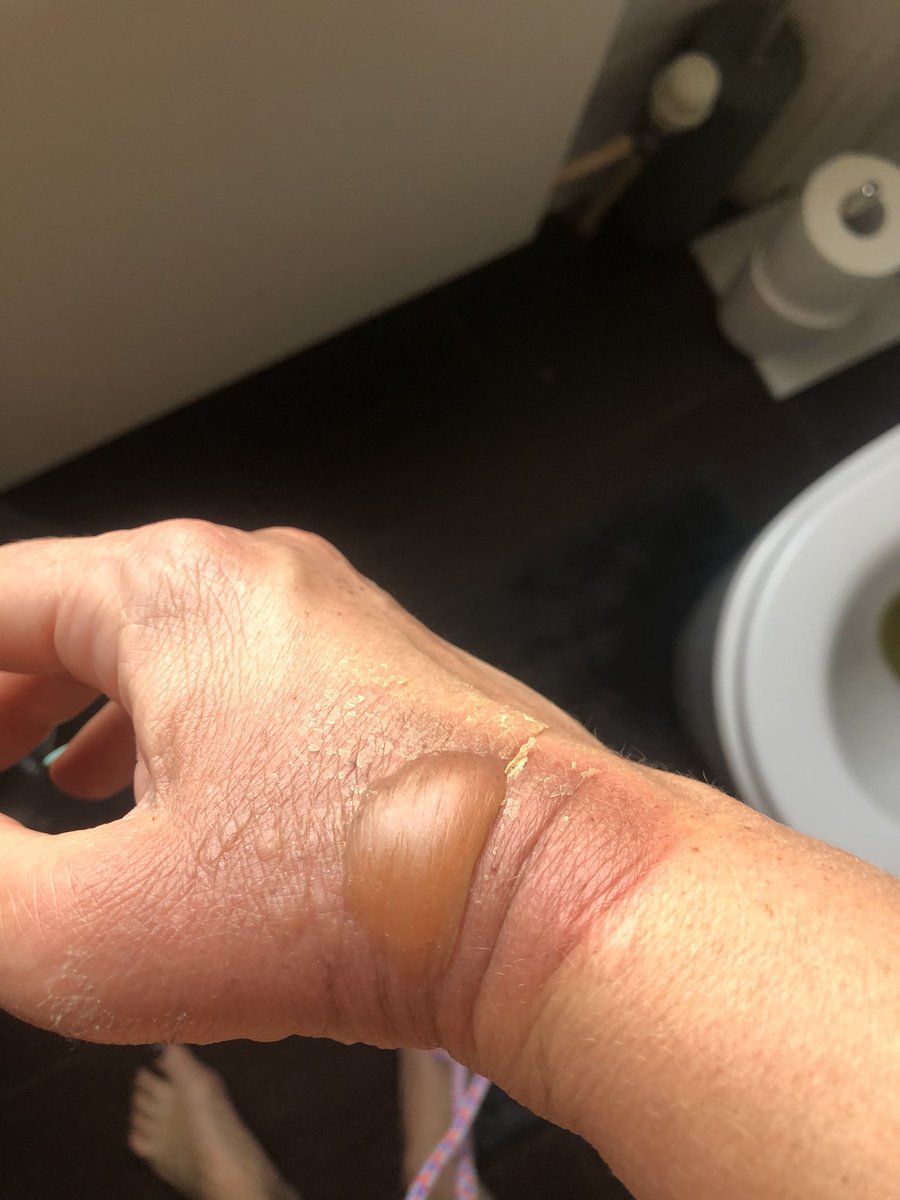 TracyAnnO's tweet photo. Hand update #BurnGate #day3 anyone worried yet . ? You’ve all been brilliant with advice and help so far xx https://t.co/w8ZRQywaqw