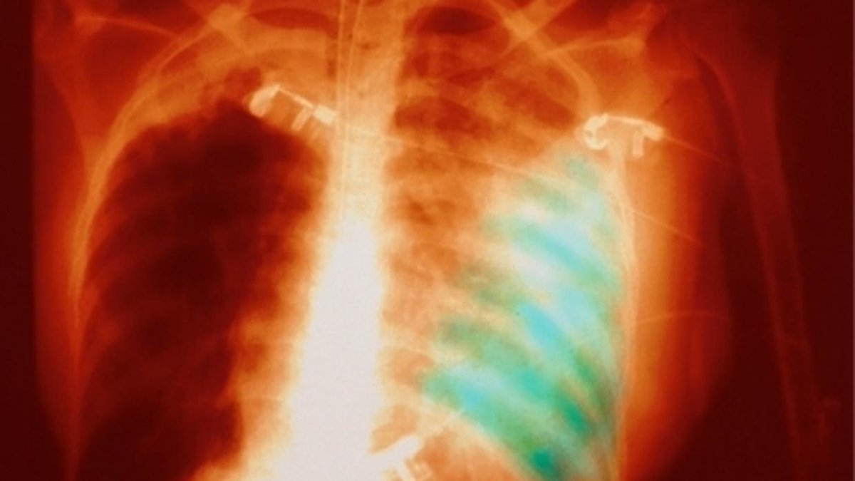 病毒疫情燒不停 全球過600萬確診 過36萬死 rfi.my/5z6u.t