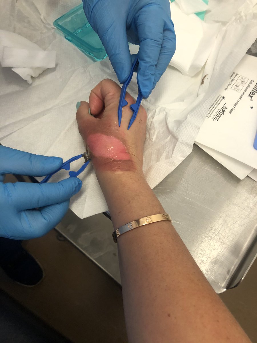 TracyAnnO's tweet photo. #burngate update . Thanks all . Nurse Ollie sorted me out @RoyalFreeNHS . Said anyone should attend a&amp;e as very safe &amp; non busy Covid areas. Here’s some pics . You’ve all been lovely Thankyou xxx w burns sterile piercing of blister remove dead skin sterile dressing #SaveOurNHS https://t.co/2tiGRWFo6E