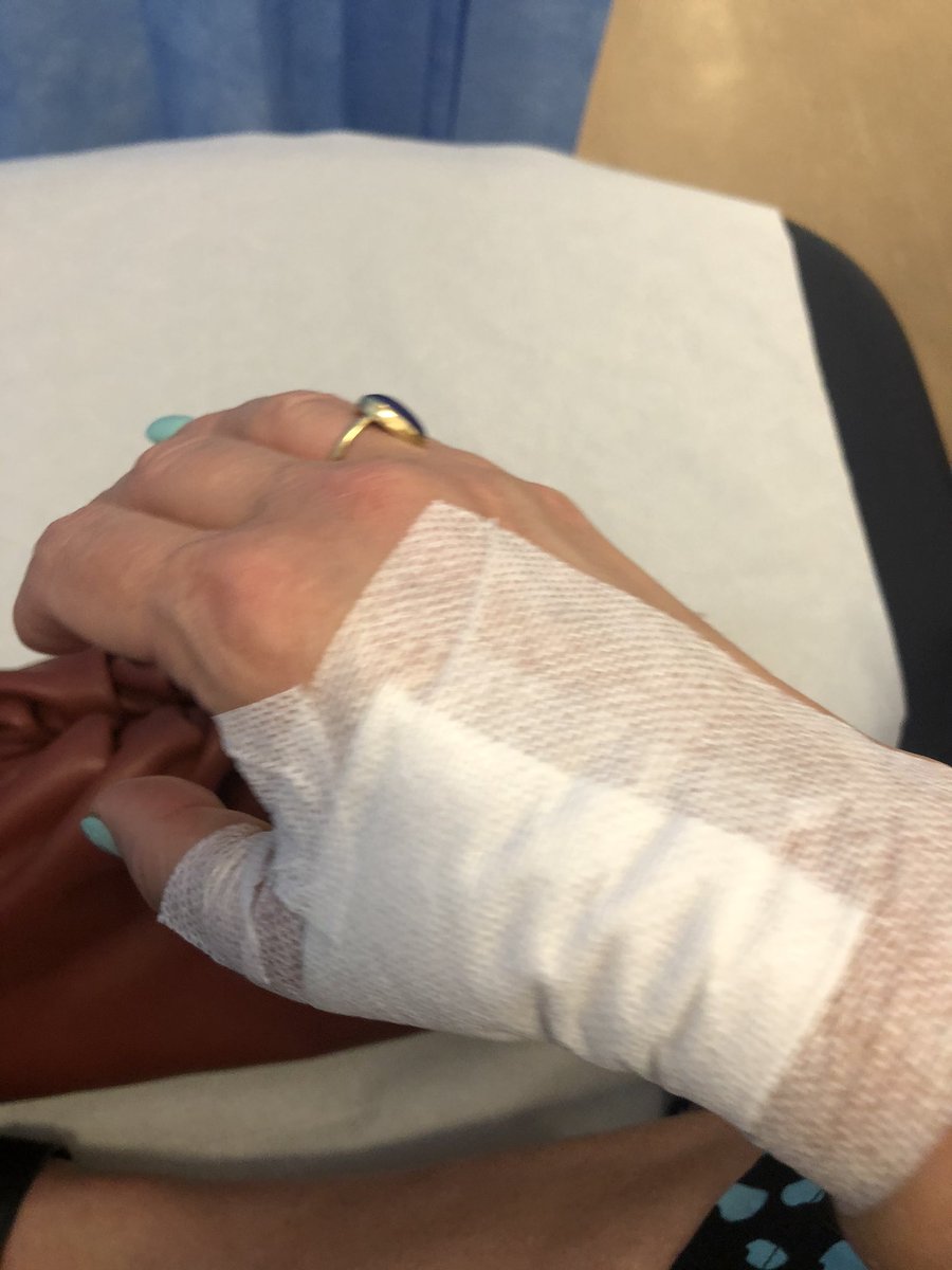 TracyAnnO's tweet photo. #burngate update . Thanks all . Nurse Ollie sorted me out @RoyalFreeNHS . Said anyone should attend a&amp;e as very safe &amp; non busy Covid areas. Here’s some pics . You’ve all been lovely Thankyou xxx w burns sterile piercing of blister remove dead skin sterile dressing #SaveOurNHS https://t.co/2tiGRWFo6E