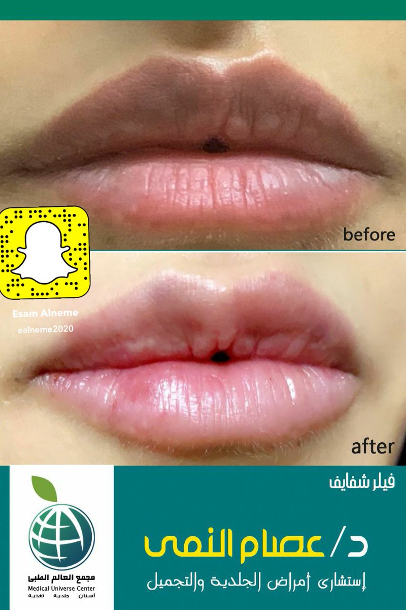 EAlneme's tweet photo. جمال الفيلر إظهار طبيعة  الشكل  وليس  التغيير فيه
#مجمع_العالم_الطبي #ابها #أبها #بنات_أبها 
#فيلر_أنف #فيلر_دقن #بوتكس #خيوط #تجميل #جلدية #جلدية_وتجميل #فيلر #الجدرة #فيلر_شفايف #أمراض_الجلدية #ل��ز #د_عصام_النمي #فيلر https://t.co/FLRLl0Hk4s