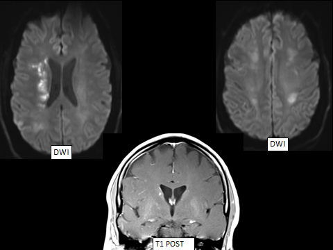 Hammerdongle's tweet photo. Dick's Pick of the Week: Intravascular Lymphoma: presenting as internal border zone infarcts  

Findings: IBZ infarcts of varying ages and faint basal ganglia enhancement, likely due to IVL predilection for deep penetrating arteries.

#FOAMed #FOAMrad #radres #NeuroRad #radiology https://t.co/aMYpSAPjKX