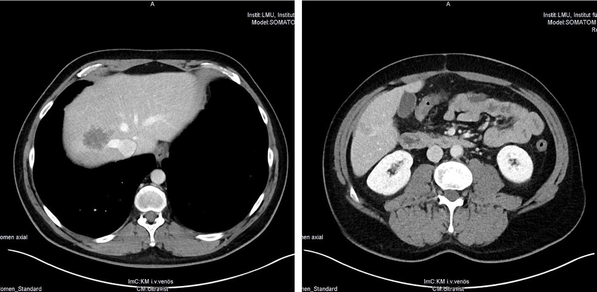 (3/6) Within weeks, tumours shrank & the patients condition improved on an almost daily basis. Within 6 months, disease burden was significantly reduced. Based on the excellent systemic response & the scans below, our team decided to explore surgical options.  @OncoAlert 