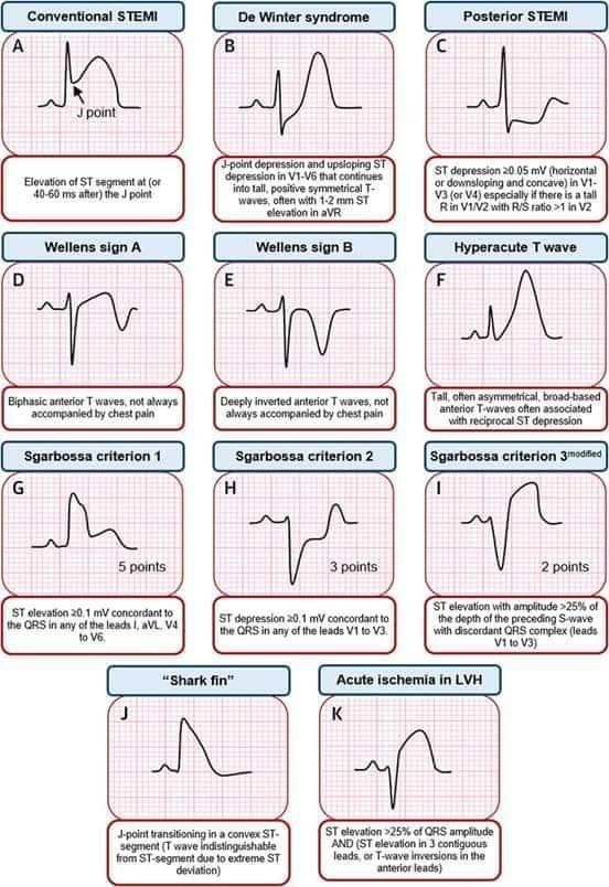 STEMI equivalent <a href="/sbrugaletta/">Salvatore Brugaletta</a> @WijnsWilliam <a href="/thiele_holger/">Holger Thiele</a> <a href="/SABOURETCardio/">SABOURETCardiologist</a> <a href="/Ortega_Paz/">Luis Ortega Paz</a> <a href="/PCRonline/">PCRonline 🫀</a> <a href="/Saar_Minha/">Sa'ar Minha, MD</a> <a href="/Dr_Iakobishvili/">Zaza Iakobishvili</a> <a href="/Israel_Mazin/">Israel Mazin</a> <a href="/BeigelRoy/">Roy Beigel</a> <a href="/InvasiveCardiol/">Journal of Invasive Cardiology</a> <a href="/EuroInterventio/">EuroIntervention</a> <a href="/ehj/">🌱</a>