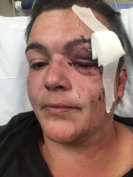 YourAnonCentral's tweet photo. Guardian photojournalist Linda Tirano covering the #GeorgeFloyd protests, deliberately targeted and shot in the eye by U.S. security forces. 

The doctors performed emergency surgery, but they were unable to save her eye. She lost her sight. #ICantBreathe #BlackLivesMatter https://t.co/4SbQi9ebW7
