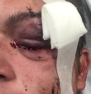 Guardian photojournalist Linda Tirano covering the #GeorgeFloyd protests, deliberately targeted and shot in the eye by U.S. security forces. 

The doctors performed emergency surgery, but they were unable to save her eye. She lost her sight. #ICantBreathe #BlackLivesMatter