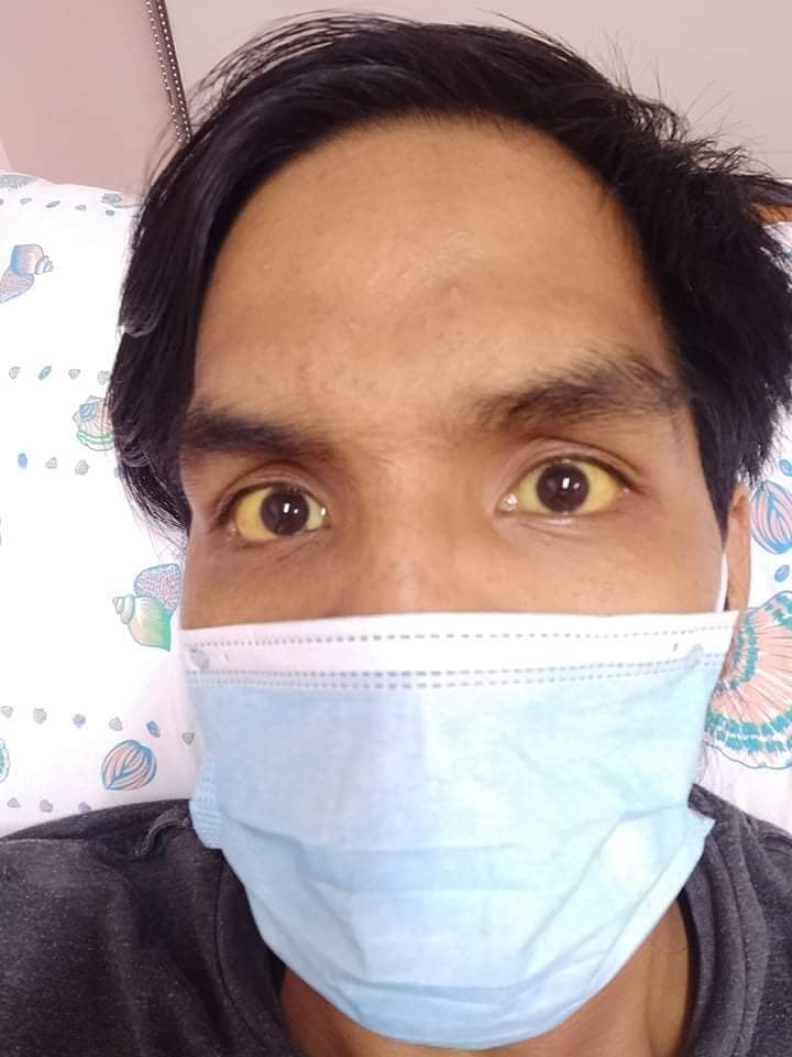 A thread:Hi twiter friends. My Name is Aldrin Tristan Tominez, asking everyone for your help financially for my upcoming surgical operation on June 01 2020 due to "Bile Duct Injury"  https://www.facebook.com/106141961126772/posts/106170861123882/?sfnsn=mo