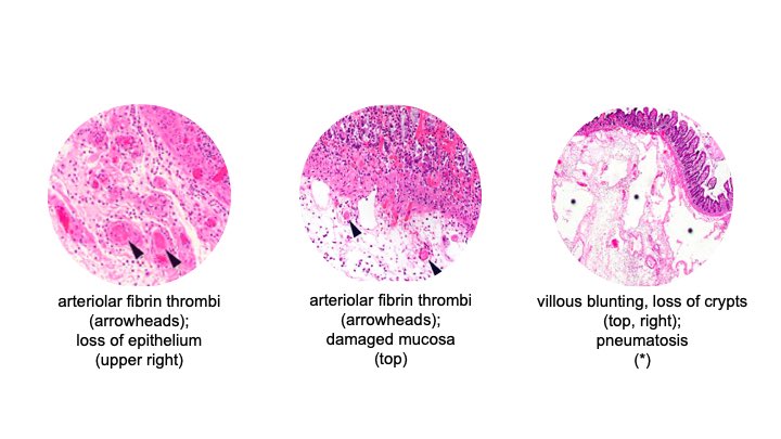 Histopathology in cases seen at the authors’ institution has shown fibrin thrombi within submucosal arterioles, villous blunting, loss of crypts, submucosal edema, and pneumatosis. 12/19